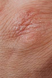 People with this disease also report feeling crawling, stinging. A Guide To Recognizing Morgellons Disease Kake