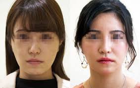 ルフォーとSSRO術後の腫れはいつまで続く? | マックスファクス銀座クリニック ブログ