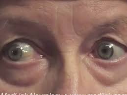 Image result for Pupillary Paralysis