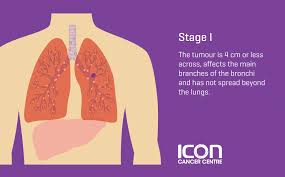 (a'man) the israeli military intelligence which produces comprehensive. Lung Cancer Types Stages Icon Cancer Centre Singapore