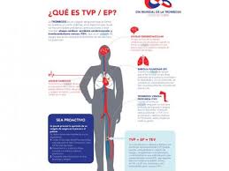 Por último, se encuentra el cáncer. Trombosis Como Se Produce Fotos Foto 1 De 3 Salud Estilo De Vida Peru Com