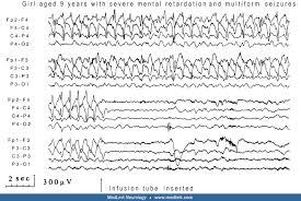 Image result for Absence Seizure