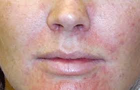 I keep getting little pimples around my chin, nostrils and mouth. Is That Stubborn Acne Really Acne Framingham Dermatology Framingham Ma Dermatologist
