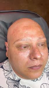 This client had a bad case of alopecia and I was able to give him some  confidence back with eyebrows! I love my job!! , #microbladingcorona  #coronamicroblading #alopecia #permanentmakeup #pmu ...