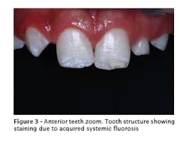 Microabrasion And Composite Resin For Re Establishing Smile Esthetics A Case Report