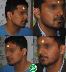 For your hair transplant in india the most trusted. Beard Facial Hair Transplant In India Reviva Clinic Chandigarh