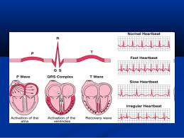 Causes of arrhythmia includes various heart conditions, diabetes, high blood pressure, thyroid disorders, stress many conditions that damage your heart can result in an irregular rhythm. Arrhythmia Irregular Heartbeat