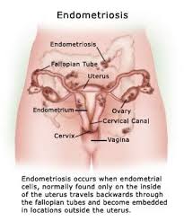 Other Endometriosis Symptoms Include Infertility Changed Menstrual Pattern Heavier Longer A Endometriosis Symptoms Endometriosis Treatment Endometriosis