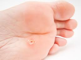 While most warts grow out of the skin, these warts grow into the skin. Warts And Skin Cancers Corns Calluses Athlete S Foot Treatment Podiatrist Darlyne Cange Dpm Llc