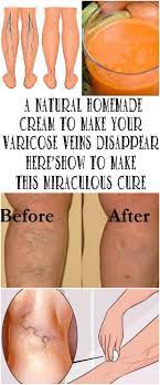 Pin On Veins