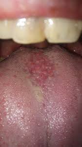 Image result for Puchýře na jazyku