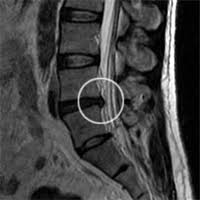 A bulging disc is different from a herniated disc because it does not rupture and affects a larger part of the disc itself; Bulging Disc Physio Works