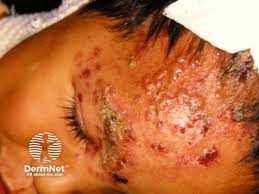 Image result for Varicella zoster on human skin