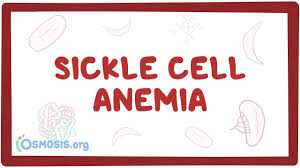 Approximately 100,000 americans have the disease. Sickle Cell Anemia Causes Symptoms Diagnosis Treatment Pathology Youtube