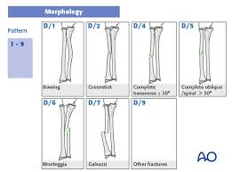 Image result for Fractures in Children