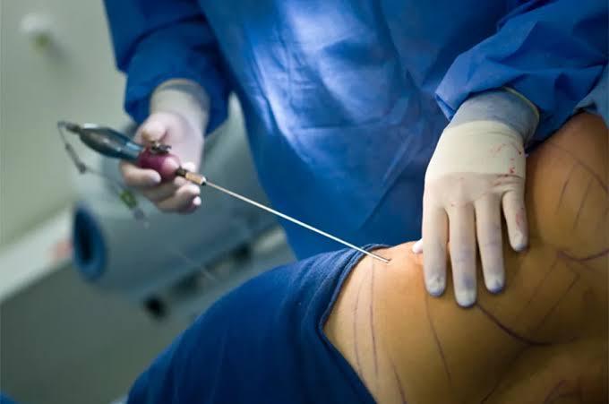 What is liposuction? | Manchester Private Hospital
