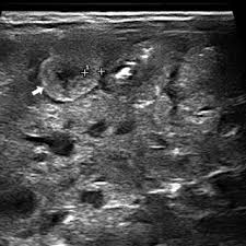 Design & installation kea designs, llc. Pdf Diagnostic Imaging Features Of Necrotizing Enterocolitis A Narrative Review