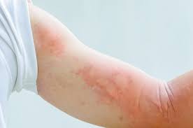 Rashes have many causes including allergic or contact dermatitis, autoimmune disease, infections, medications and rarely, cancer of the skin. Here S How To Tell If A Rash Is Really Serious