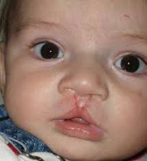 The University of New Mexico Cleft and Craniofacial Clinic