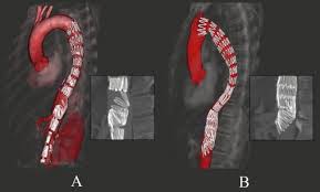 Cook medical inc., www cookmedical.com. Stent Misalignment Of The Zenith Dissection Endovascular System Sciencedirect