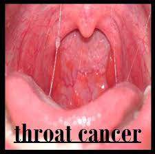 According to the national cancer institute, about 1.2 percent will be diagnosed with oral cavity and pharyngeal cancer and 0.3 percent will be diagnosed with laryngeal cancer within their. Early Stage Throat Cancer Images Celine Dion Songs Age