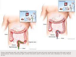 Symptoms can also vary according to the specific location. Colon And Rectal Cancer Follow Up Care Expanded Version Ascrs