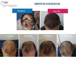 Repousse Des Cheveux Apres Greffe Fue Mois Par Mois Blog Sante
