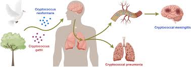 Image result for Cryptococcal Meningitis