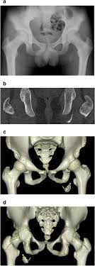Severe pelvic fractures can be fatal due to internal bleeding or damage to nearby organs, or result in chronic pain and physical disabilities. Avulsion Fracture Of The Ischial Tuberosity Treated With The Suture Bridge Technique A Case Report Bmc Musculoskeletal Disorders Full Text