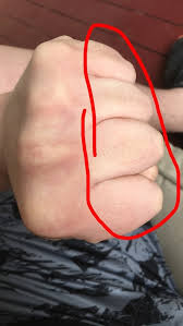What Damage Can A Brass Knuckle Punch Produce Quora