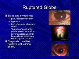 Hyphema