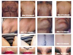 We use the high speed lightsheer duet laser for hair removal and with this truly innovative technology, we are able to reduce our treatment times by up to 75% and offer little discomfort to the client. Ipl Hair Removal