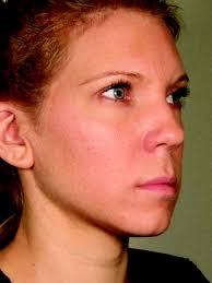 Before & After Cosmetic Treatments West Orange NJ