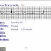 Symptoms can include shortness of breath, chest pain, decreased ability to exercise, and an irregular heartbeat. 1
