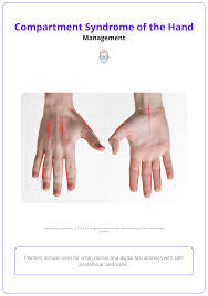 Image result for Compartment Syndrome