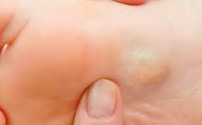 May 31, 2018 · after a couple days they'd burst or something, and my foot would have an ugly bruise but the lump and pain would be gone. Plantar Fibromas Lumps In The Arch Of The Foot Podiatry Network