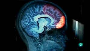 Pero, ¿qué es el síndrome de asperger? Cerebro Asperger Lobulo Frontal Video Dailymotion