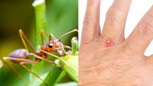 Image result for Fire Ant Sting
