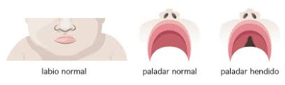 El labio leporino y el paladar hendido se producen cuando las estructuras faciales que se desarrollan en un bebé nonato no se cierran por completo. Labio Leporino Y Paladar Hendido Johns Hopkins All Children S Hospital