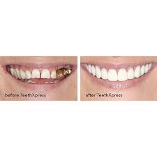 Check spelling or type a new query. 4 Things To Know About Teethxpress Dental Implants