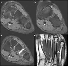 Lateral and medial processes of calcaneal tuberosity, and band of connective tissue connecti. Mri Appearance Of Jogger S Foot Springerlink