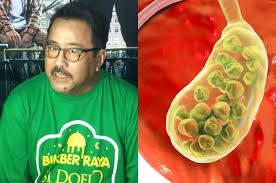 Sebagai alat ekskresi yang mengeluarkan warna empedu dan urine. Rano Karno Kehilangan Empedu Hati Hati Gejala Batu Empedu Sering Dikira Sakit Maag Ini Bedanya Semua Halaman Intisari