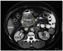 Doctors may also do tests to many cancer centers use a special ct scan method called a pancreatic protocol ct scan. Radiology