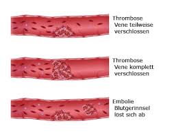 Thrombosespritze wann notwendig ab wann wird eine thrombose gefahrlich thrombosespritze beim unterschenkelgips oder nach kneispiegelung Nach Op Thrombose Und Embolie Mit Heparin Vorbeugen