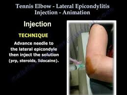 Image result for Elbow Joint Injection