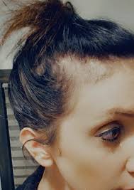 Keto and hair thinning in long-term users