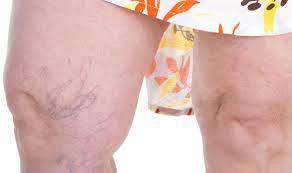 Suffering From Pelvic Congestion Syndrome Experts Describe Symptoms And Treatment Express Co Uk