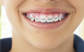 Memakai pendakap gigi adalah kaedah biaa untuk melurukan gigi bengkok dan menyelarakan gigitan anda dengan betul.ebelum anda mendapat pendakap semasa proses, anda mungkin merasakan tekanan dan sensasi mencubit ketika spacer turun ke garis gusi anda. 7 Makanan Yang Perlu Dielak Bagi Si Pendakap Gigi Free Malaysia Today Fmt