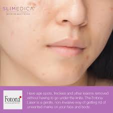Pin On Fotona Laser Treatments