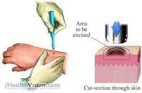 Treatment for xanthelasma surgical resection is one of the most commonly used techniques, especially with the xanthelasmas are on the upper eyelid. Xanthelasma And Xanthoma Definition Causes Symptoms Complications And Cost Surgery Treatment Hospital In India